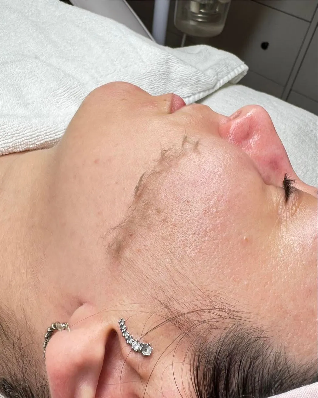 Travel and beauty Australia|What Qualifications Are Required to Perform Dermaplaning?